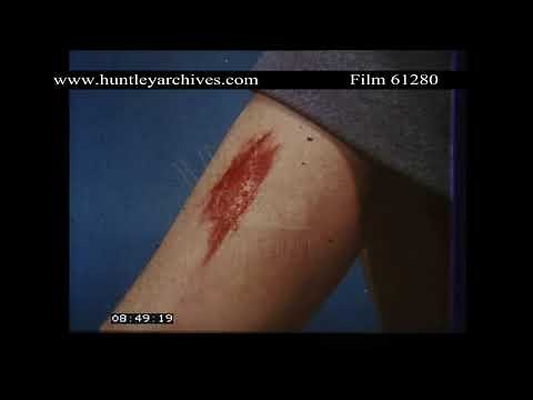 Different Types of Wound and Blood Loss. Archive film 61280