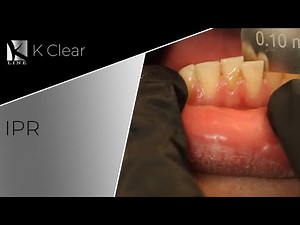 Interproximal Reductions/Teeth Stripping-reshaping in Clear Aligners Treatment