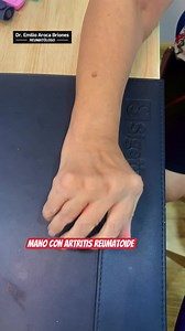 Así es una mano destruida por la artritis reumatoide, no esperes que te pase esto. | REUMASUR (Centro de enfermedades Reumáticas y Autoinmunes)