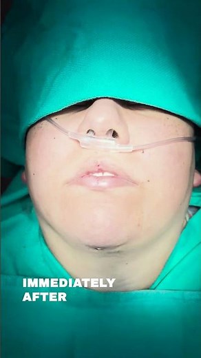 Non-Surgical Neck Lift & Buccal Fat Removal | Stunning Before & After #necktite #necklift