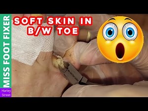 SOFT SKIN IN B/W TOE | CALLUS ON FOOT | FOOT WOUND TREATMENT BY Miss Foot Fixer