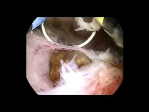 TURP bipolar (Transurethral Resection of the Prostate)