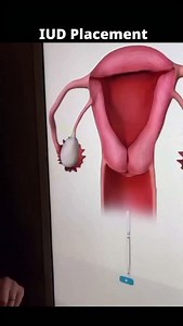 An Intrauterine Device (IUD) is a small, T-shaped device inserted into the uterus for long-term contraception. 1.Consultation: Medical history, .pregnancy test, STI screening. 2.Preparation: Lie down, pelvic exam, pain relief (if needed). 3.Speculum: Inserted to view cervix. 4.Cleaning: Cervix cleaned with antiseptic. 5.Uterine Measurement: Depth checked with uterine sound. 6.IUD Insertion: Device loaded into applicator, inserted into uterus. 7.String Trimming: Strings cut for later removal. 8.P