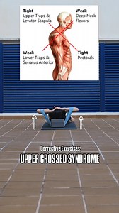 17K views · 793 reactions | Upper Cross Syndrome is a postural...