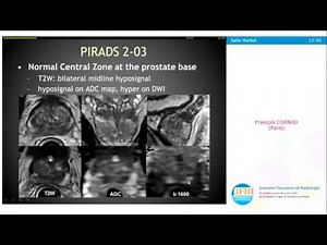 IRM de diffusion de la prostate