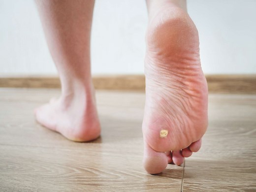 What Are Plantar Warts—and How Do You Get Rid of Them?