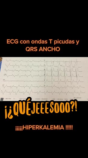 ECG paciente insuficiencia renal sin diálisis hace 1 semana, PCR recuperado @Enfermeria, Urgencias y salud #enfermeria #emergencia #urgencia