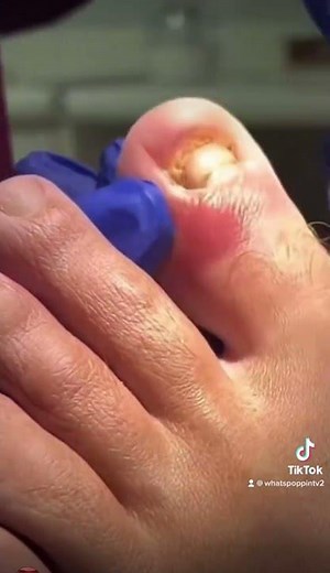 Abscess pop pus