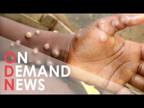 Monkeypox: EVERYTHING You Need to Know About New Virus