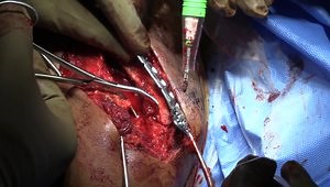 Lateral Third Distal Clavicle Fracture ORIF and CC Reconstruction