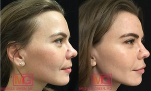 Laser Skin Resurfacing, Types of Laser Skin Treatment - Dr. Michele Green M.D.