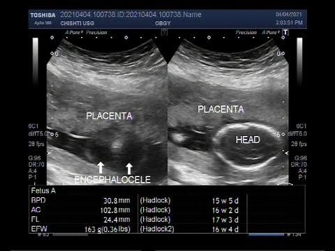 Fetal demise in pregnancy of about 16 weeks with an encephalocele.