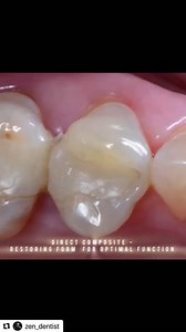 #Repost Dr Vishal Gupta ・・・ Daily mindful dentistry 😌 #rubberdam #minimalinvasivedentistry #bioesthetics #estheticdentistry #dentalesthetics #adhesivedentistry #restorativedentistry #responsibledentistry #dentalcourses #dentaleducation #compositecourses #chaicoffeeanddentistry #vishalsdentalworld #dentist #dental #dentistry #biomimetidentistry #biomimetic #aestheticdentistry #dentalfillings #compositefillings #compositefillings #dentalart #dentalbeauty #ripeglobal | RipeGlobal