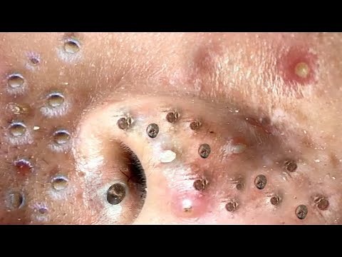 blackheads new 2023 | popping pimple today | blackheads and whiteheads removal