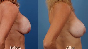 Capsular Contracture: The Doctor Explains Solutions to Minimize Your Risk