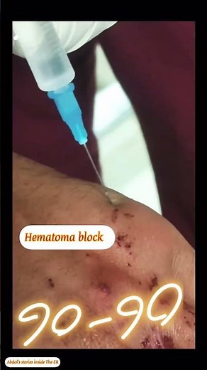 Quick Fix: 90-90 Technique in boxer's fracture