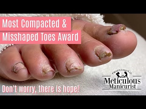 How to Pedicure Transformation the Most Compacted & Misshapen Toenails