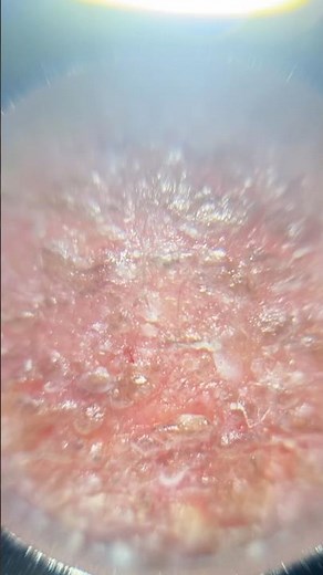 Skin burn under microscope😳shocking| how to maintain burns #skindamage #irritatedskin #skindefect