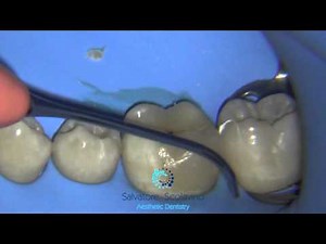 Onlay Cementation • Video • MEDtube.net