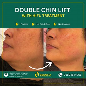Double chin Treatment #doublechintreatment | Sedona Aesthetic Derma & Laser Center