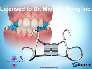 An expander is an often used appliance in early orthopaedic treatment to address crossbites, crowding and midline discrepancies. Please share this if you or anyone that you know has or is considering having an expander. See me for a complimentary consultation if you would like to know more about an expander, its risks and benefits, or if your child would benefit from having one. #expander #Hyrax #Dolphin #earlytreatment #PhaseOne | Dr. Michele Wang Inc.