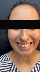 Elle retrouve enfin un sourire harmonieux et éclatant ✨ Pour corriger l’excès gingival d’un côté, nous avons réalisé une gingivectomie, conçu une prothèse fixe sur-mesure et complété le résultat par un blanchiment des dents inférieures afin d’obtenir une harmonie parfaite du sourire 😍 le tout grâce à notre expertise et notre savoir-faire pour offrir un sourire qui dure 👌 Réservez votre consultation dès maintenant 👇🏻 📞0558169578 📍BLIDA 🧑‍💻www.karadentalcenter.com #sourire #blida #algerie 