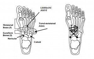 Midfoot Arthrodesis - Foot Pain Treatment in Roswell, GA