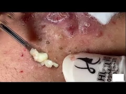 Acne Treatment | Big Cystic Acne Blackheads Extraction Whiteheads Removal Pimple Popping #11