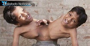 Unidos por el corazón y por el cuerpo, así son los Siameses Sahu