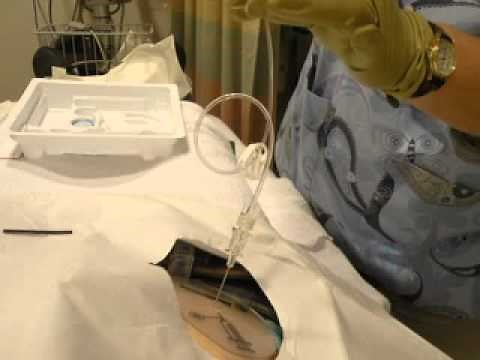 Refilling a Medtronic Painpump.mov