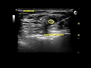 Deep peroneal nerve block