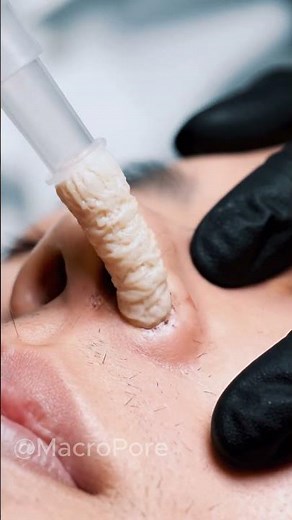 VACUUM EXTRACTION — This Pore Was Packed 😮 #blackheads