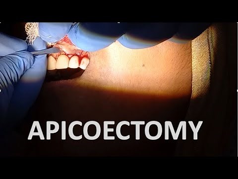 APICOECTOMY// SURGERY// STEPS IN APICOECTOMY// INDICATIONS AND CONTRAINDICATIONS// ‪@dentalcafe4331‬