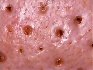 Microscope photography Perfect clear! Pore Care! Elizavecca Hell-Pore clean up mask Pack