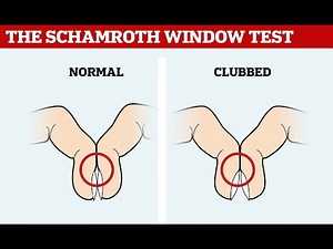 Schamroth's Sign or Schamroth window test indicating Finger Clubbing ; Procedure and meaning