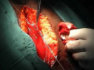 Total Abdominal Hysterectomy: Incision and opening of the pelvic cavity