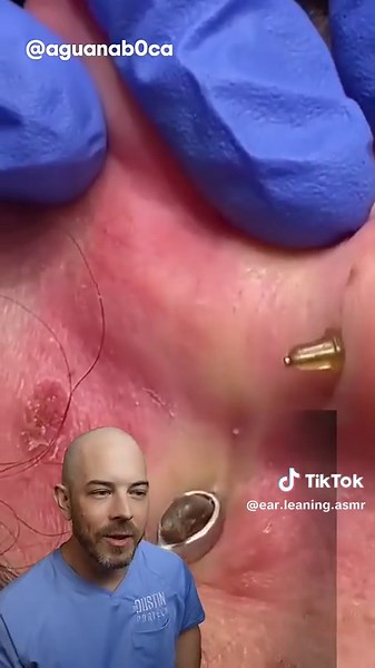 This is an iconic ear cyst extraction! #doctor #satisfying #viral - #squeezeyuk #acne #pimple #pimplepop #blackhead #satisfying #foryoupage #foryou #تنظيف_بشره #whiteheads #رؤوس_سوداء #عنايه_بالبشره #دهون