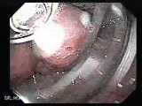 Gastro-Esophageal Varices - Presentation of the Varices in the Cardia, Part 1 • Video • MEDtube.net