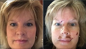 Woman shares graphic images to spread skin cancer warning