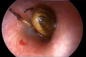 18K views · 208 reactions | Cette personne avait un insecte coincé...