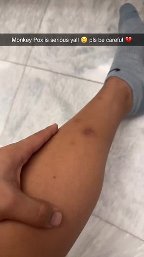 Understanding Monkeypox: Symptoms, Effects, and Prevention