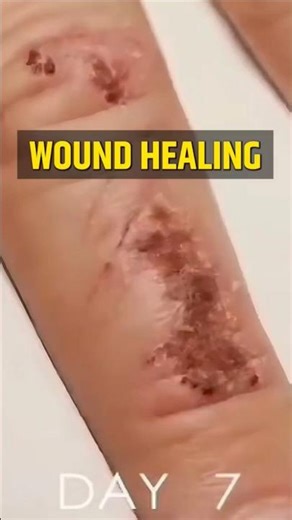Wound Healing Process (In Hindi) #woundhealing #process #wound #inhindi # #ytshorts #shorts