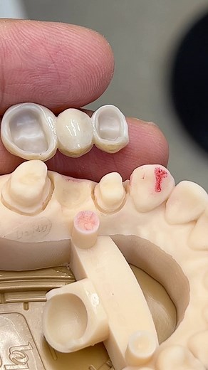 Ovate Pontic with Monet pure zirconia! | CEO Luke Kahng