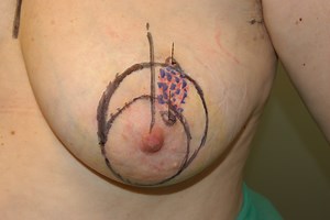 Round-Block. Mamoplastia Circular - Breast Surgeons Web