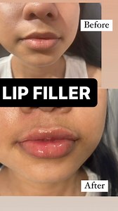 16K views · 30 reactions | Lip filler before and after ❤️✨ | Dr. Sarah Fazy / Dr. Cherry | Facebook