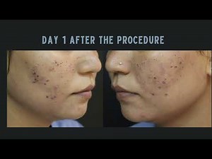CO2 Laser Treatment for Acne Scars in 2 minutes | CO2 Laser Treatment Day 1 to Day 5 Before After
