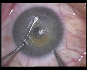 SMILE Procedure: Updated Technique - Eyetube