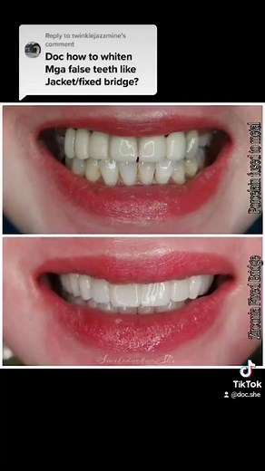 Can you WHITEN FALSE TEETH LIKE BRIDGE/ CROWN??? #dentaltips #dentaladvice #teethwhitening #denture #dentureclinicph #fixedbridge #dentalcrown #zirconiacrown #teethcare #dentureclinicphilippines #dentistmanila #dentistphilippines #dentistph #dentistofinstagram #dentureclinicnearme #smilemakeover #smiletransformation #veneers #porcelaincrowns #dentaladvice #docshe #smiledoctor #dentureclinicmanila #digitalcrowns #digitaldentistry #teethmakeover #bestdentalclinic #teethgoals | Doc She - Your Smile