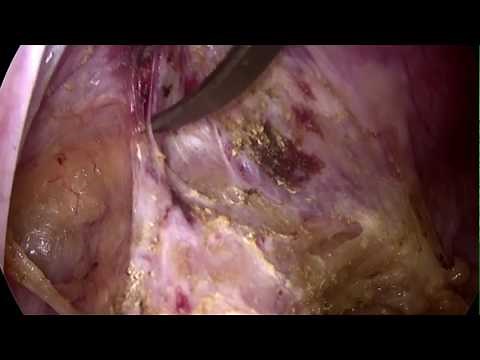 Laparoscopic Ventral Mesh Rectopexy