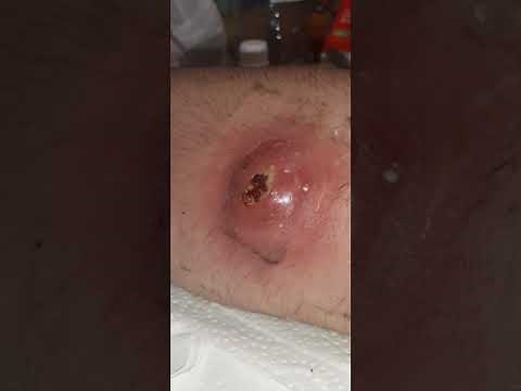Biggest Boil Ever, MRSA Infection Pt.1